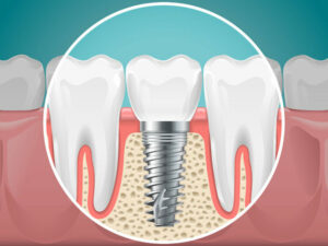 image-implants-dentaires