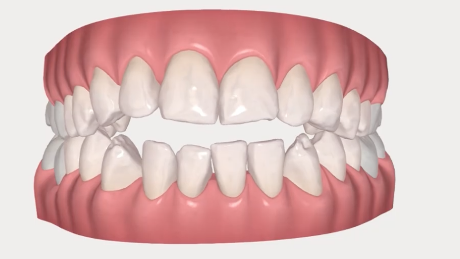 Tout savoir sur le traitement Invisalign - Cabinet dentaire Libération